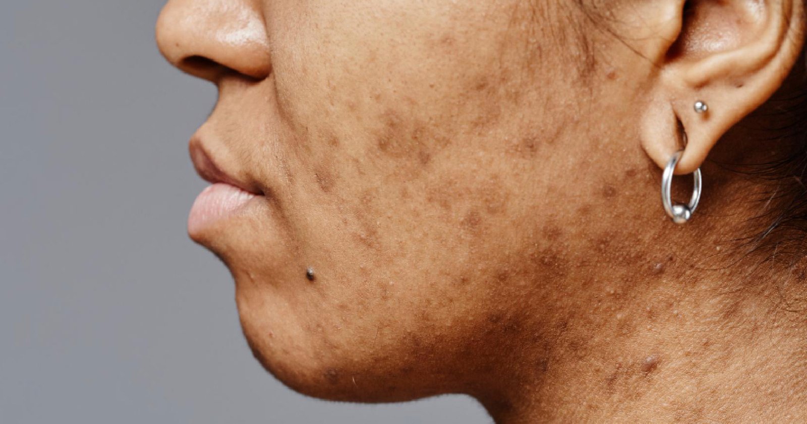 acne scar treatment in bangalore